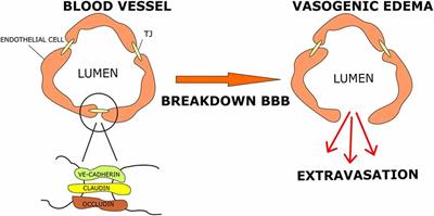 Dexamethasone in Glioblastoma Multiforme Therapy: Mechanisms and Controversies